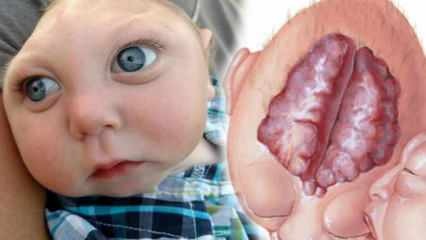 Was ist Anenzephalie? Was sind die Symptome der Anenzephalie bei Säuglingen und Kindern? Anenzephalie verursacht ...
