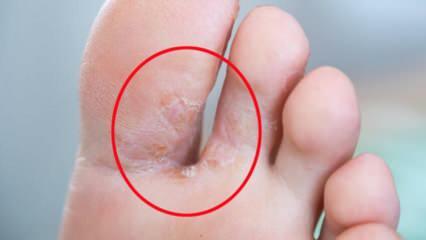 Was ist Fußpilz? Was sind die Symptome eines Fußpilzes? Gibt es ein Heilmittel für den Fußpilz?