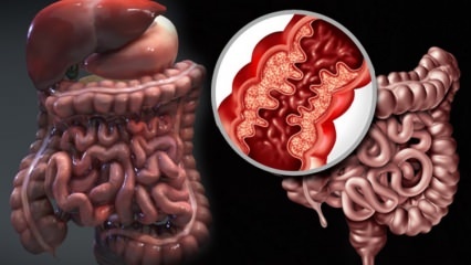 Was ist Morbus Crohn? Was sind die Symptome von Morbus Crohn? Gibt es ein Heilmittel für Crohn?