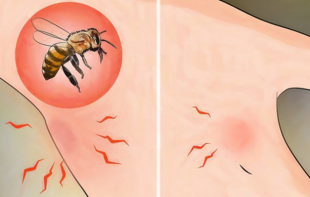 Was ist eine Bienenallergie und was sind die Symptome? Natürliche Methoden, die gut für Bienenstiche sind