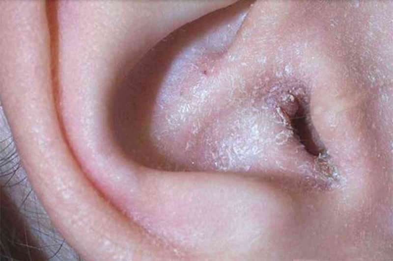 Was verursacht ein Peeling hinter dem Ohr und wie geht es vorbei? Die endgültige Lösung für Hinter-dem-Ohr-Ekzeme ...
