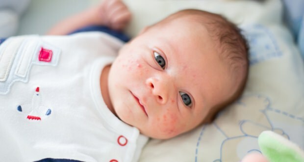 Warum tritt Akne bei Babys auf?