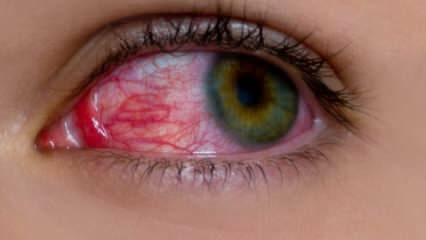 Was verursacht eine Augenallergie? Was sind die Symptome einer Augenallergie? Was ist gut für Augenallergien? 