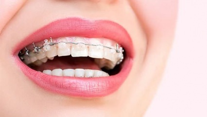 Warum sind Zahnspangen angebracht? Was sind die Arten von Zahnspangen?