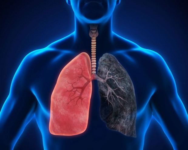 Was ist Lungenkrebs?