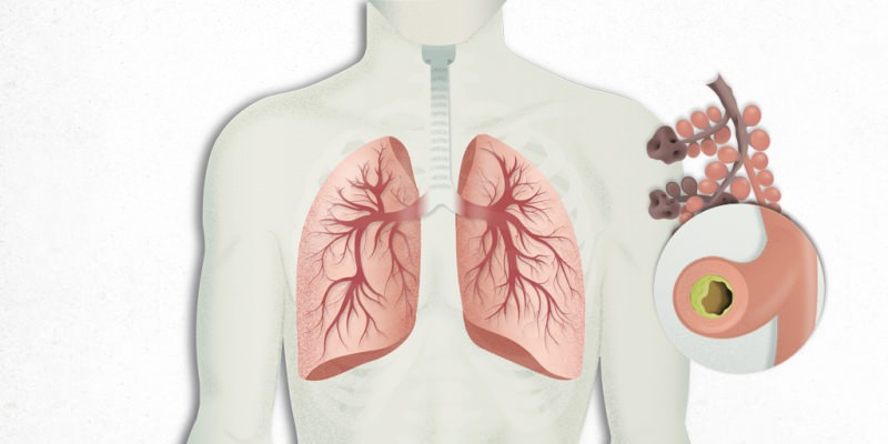 Das Virus, das sich in der Lunge ansiedelt, ist mit einer Lungenentzündung vermischt