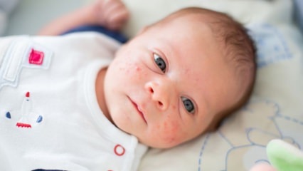 Wie geht Akne auf das Gesicht des Babys über? Trocknungsmethoden für Akne (Milia)