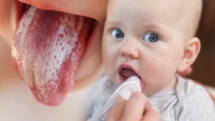 Symptome und Behandlung von Soor bei Säuglingen! Wie wird Soor bei Säuglingen übertragen? Die genaue Lösung ...