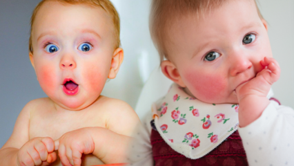 Achtung bei Babys mit roten Wangen! Schlagwangensyndrom und seine Symptome