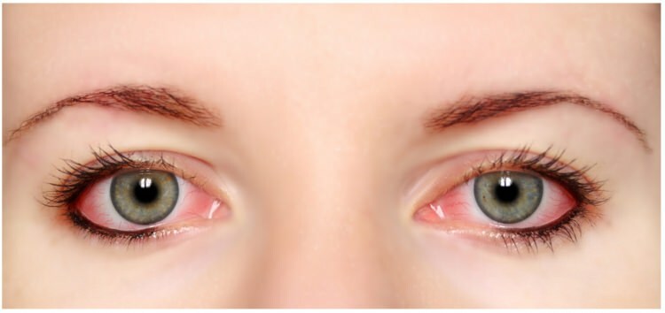 Hat Mascara und Eyeliner Allergie in den Augen?