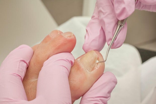 Was verursacht eingewachsene Zehennägel und was sind die Symptome? Natürliche Wege, die gut für eingewachsene Nägel sind ...