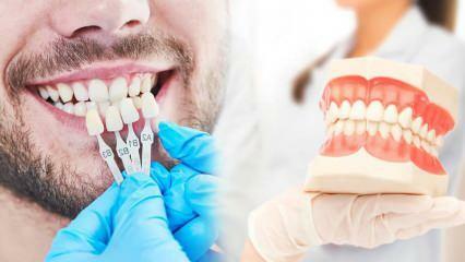 Warum wird Zirkonium-Veneer auf die Zähne aufgetragen? Wie haltbar ist die Zirkonbeschichtung?