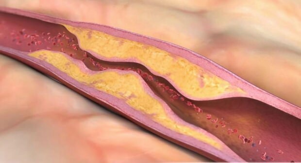 Was verursacht Arteriosklerose? Wie viele Arten von Gefäßverschlüssen gibt es?