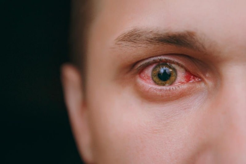 Augen tränen, bluten und jucken Coronavirus Symptome