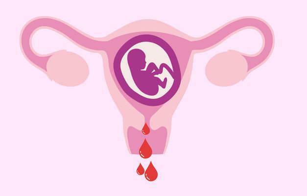 Ursachen von Blutungen während der Schwangerschaft