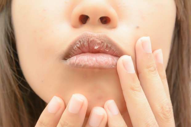 Anämie verursacht trockene Lippen