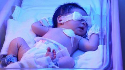 Was ist Neugeborenen-Gelbsucht? Wie geht Gelbsucht bei Babys zu Hause vorbei? Grad der Gelbsucht bei Säuglingen