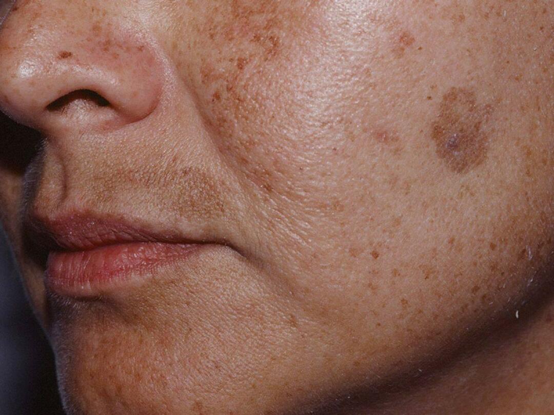 Was ist das Fleckenprotokoll und wie wird es durchgeführt? Schadet das Blemish Protocol der Haut?