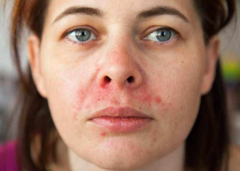 Warum tritt Akne um die Lippe auf? Wie wird periorale Dermatitis behandelt?