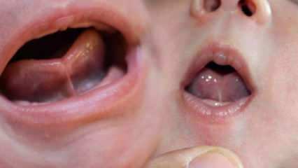 Was ist die Zungenbindung (Ankyloglossi) bei Säuglingen? Zungenbindungssymptome und Behandlung ...