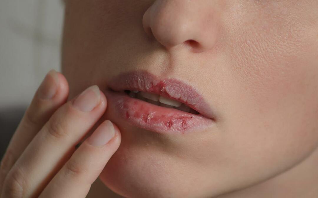 Was verursacht dunkle Lippen? Wie wird Lippenverdunkelung oder Blutergüsse behandelt?