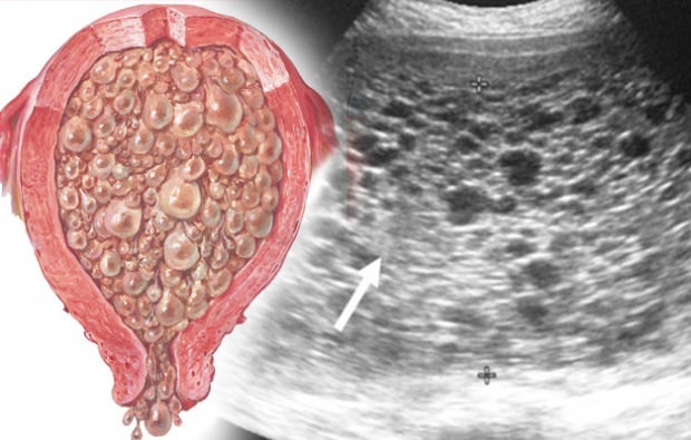 Was ist Traubenschwangerschaft Symptome der Traubenschwangerschaft