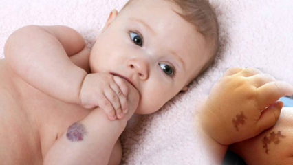Verursacht Muttermal bei Babys, ist es dauerhaft? Was sind die Arten von Muttermalen? Heilung von Saracoglu