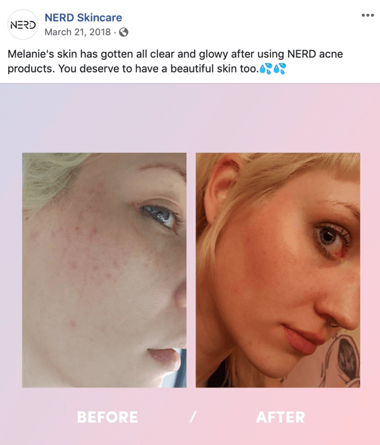 Beispiel dafür, wie Nerd Skincare ein Vorher-Nachher-Bild verwendet hat, um einen Image-Beitrag für soziale Medien zu erstellen, der den Kauf ihrer Produkte fördert.