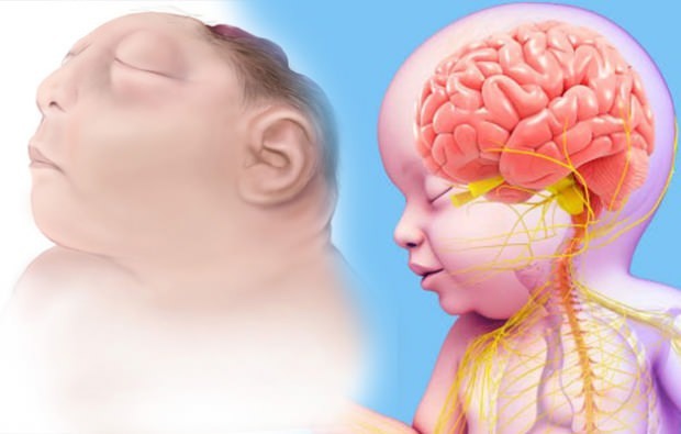 Lebt Anencephaly Baby? Anenzephaliediagnose