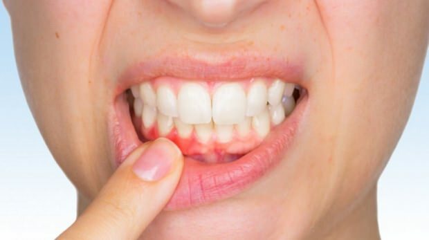Häufige Zahnfleischprobleme