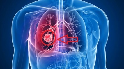 Symptome von Lungenkrebs: Stadien von Lungenkrebs!