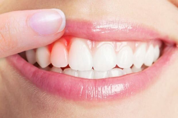 Was verursacht Zahnfleischblutungen?