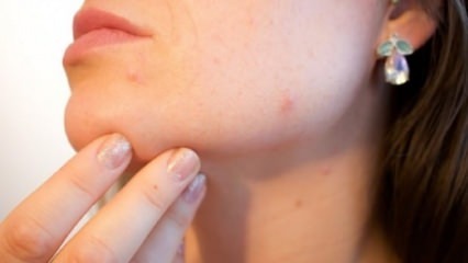 Natürliches Heilmittel gegen Akne am Kinn