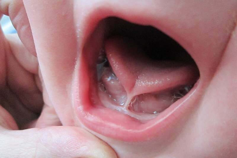 Symptome und Behandlung der Zungenbindung bei Säuglingen