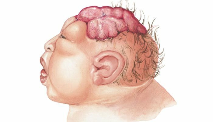 Was ist Anenzephalie? Was sind die Symptome der Anenzephalie bei Säuglingen und Kindern? Anenzephalie verursacht ...