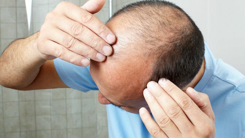 Verhindert eine Haartransplantation Ghusl?
