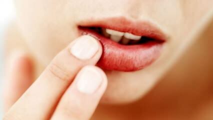Was ist gut für Lippenrisse?