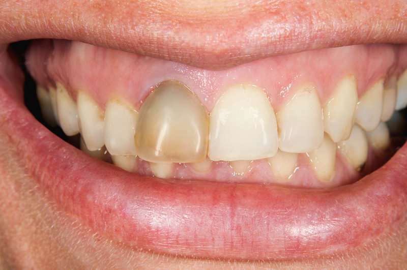 Zahnverdunkelung kann sich manchmal auf einen Zahn konzentrieren