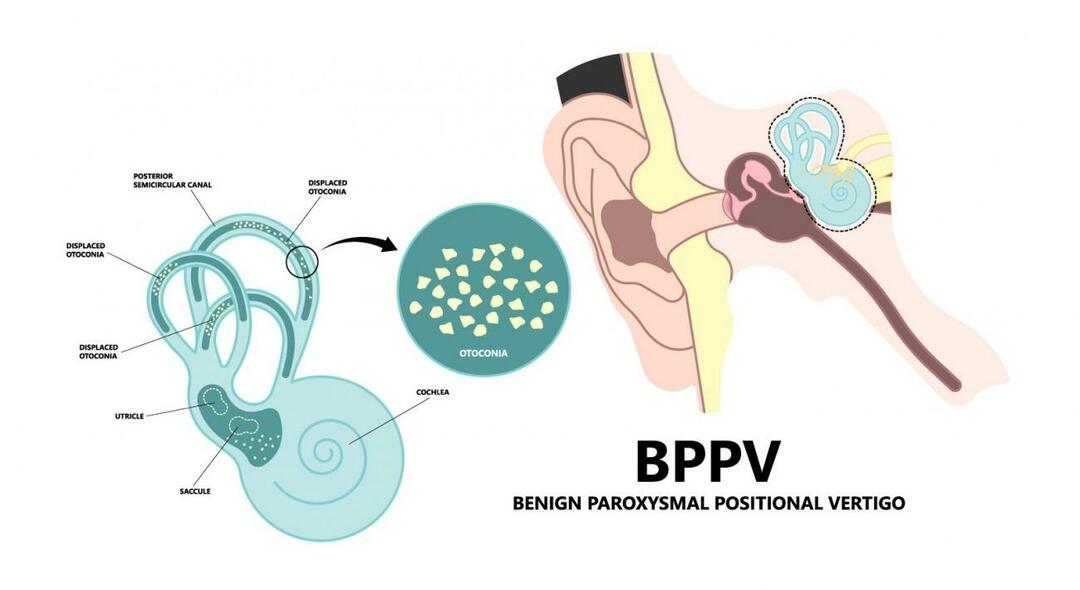 Warum dreht sich der Kopf im Liegen? Was ist gut bei gutartigem paroxysmalem Lagerungsschwindel? So werden Sie BPPV los