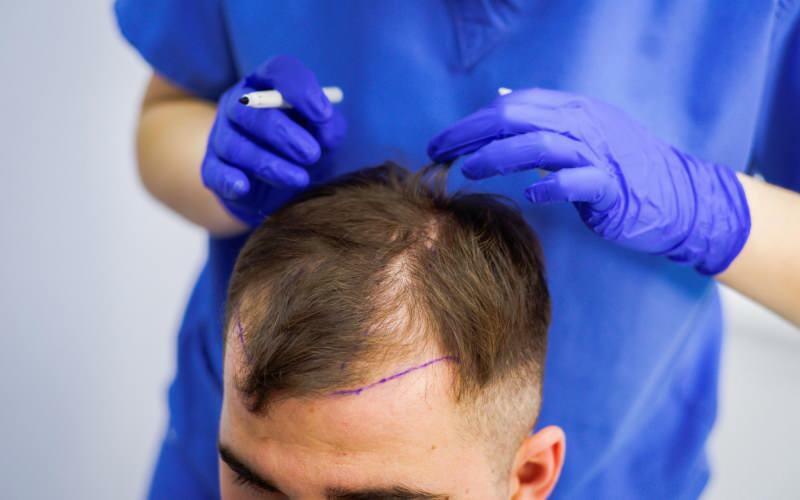 Ist eine Haartransplantation zur Behandlung von Haarausfall zulässig? Was ist Haarprothese? Beeinträchtigt Haarprothese Ghusl?