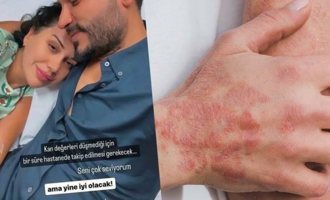 Woran ist Dilan Polat erkrankt? Was verursacht die Lupus-Erkrankung? Was ist die Schmetterlingskrankheit von Dilan Polat?