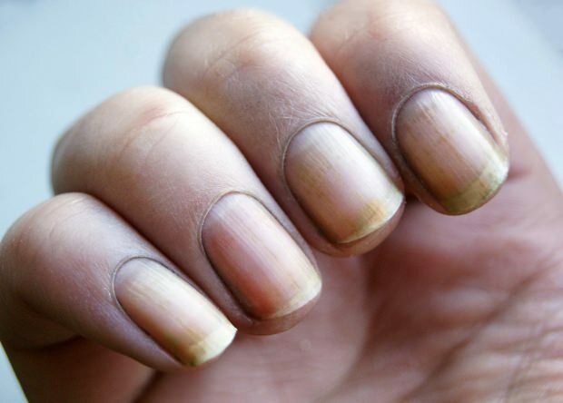 Warum wird der Nagel gelb? Wie man Nägel aufhellt, die vom Nagellack gelb werden?
