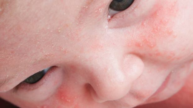 Wie geht Akne bei Säuglingen über?
