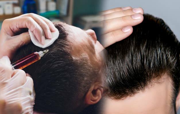 Ist es zulässig, Haare zu transplantieren? Was ist Haarprothese?