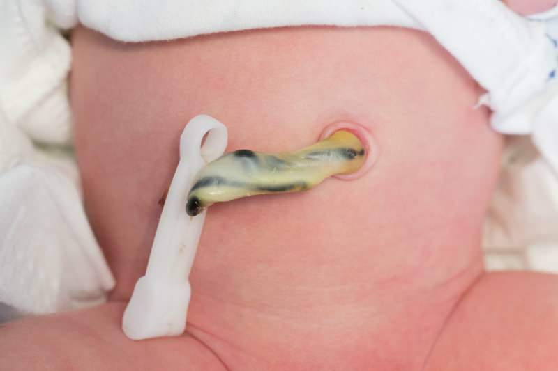 Wann fällt die Nabelschnur bei Babys ab?