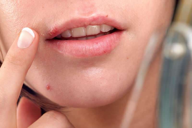 Herpes tritt normalerweise am Rand der Lippe auf.