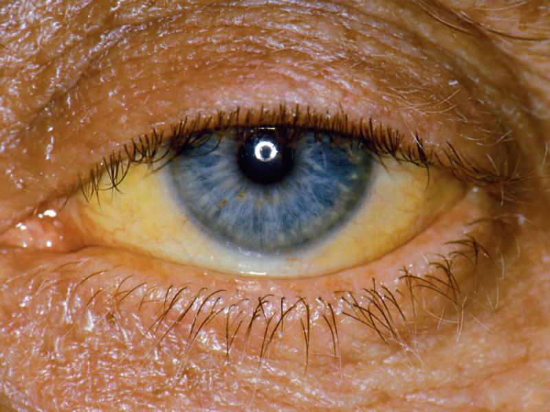 Höhe auf Bilirubin-Niveau verursacht gelbe Farbe auf den Augen und der Haut