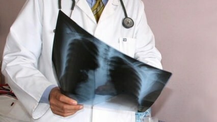 Experten angekündigt! Zunahme der Todesfälle durch Lungenkrebs