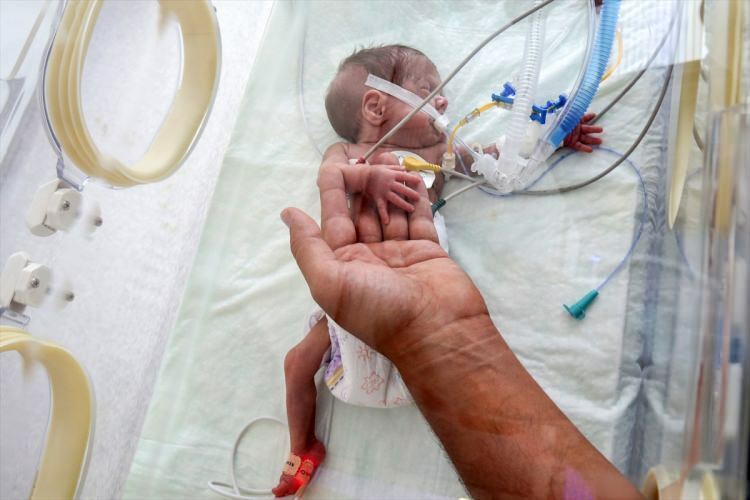 'Miracle Baby' hat die Operation überlebt