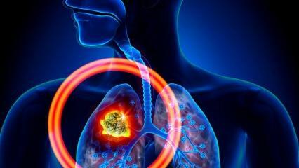 Was sind die Symptome von Lungenkrebs? Gibt es eine Behandlung für Lungenkrebs?